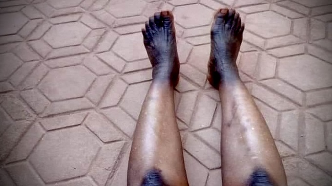 Gabon : les dangers de la dépigmentation sur le fœtus